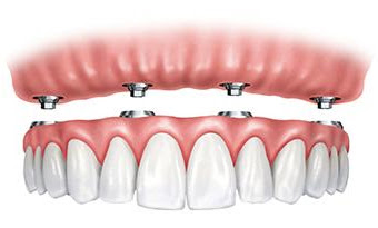 Full Arch Implant Bridges are an ideal long-term solution to your tooth loss. Since the technique has been in used for 20 years, you can take comfort in our predictable results. And our in-house CT scanner provides even more precise planning and placement. Get a free consultation to see if Full Arch Implant Bridges are right for you. Call River City Dental Dental at 907-335-0363